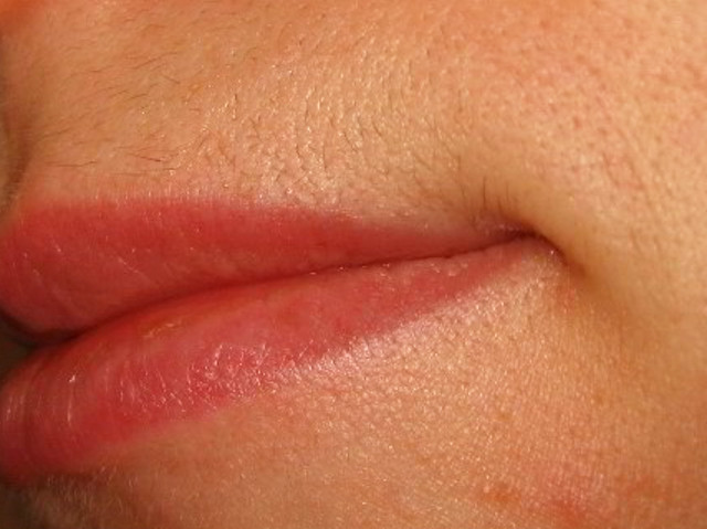 верхняя губа после лазерной эпиляции