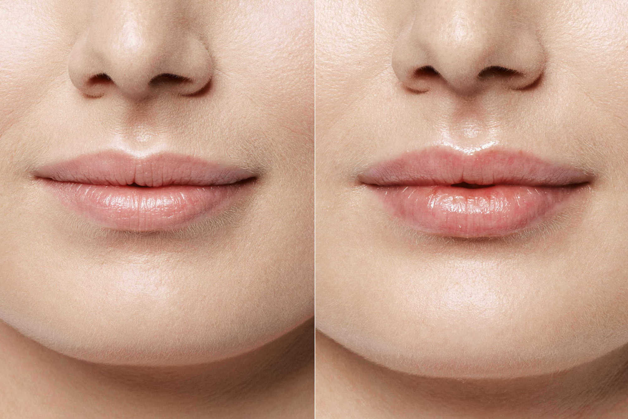 Подколотые губы фото до и после